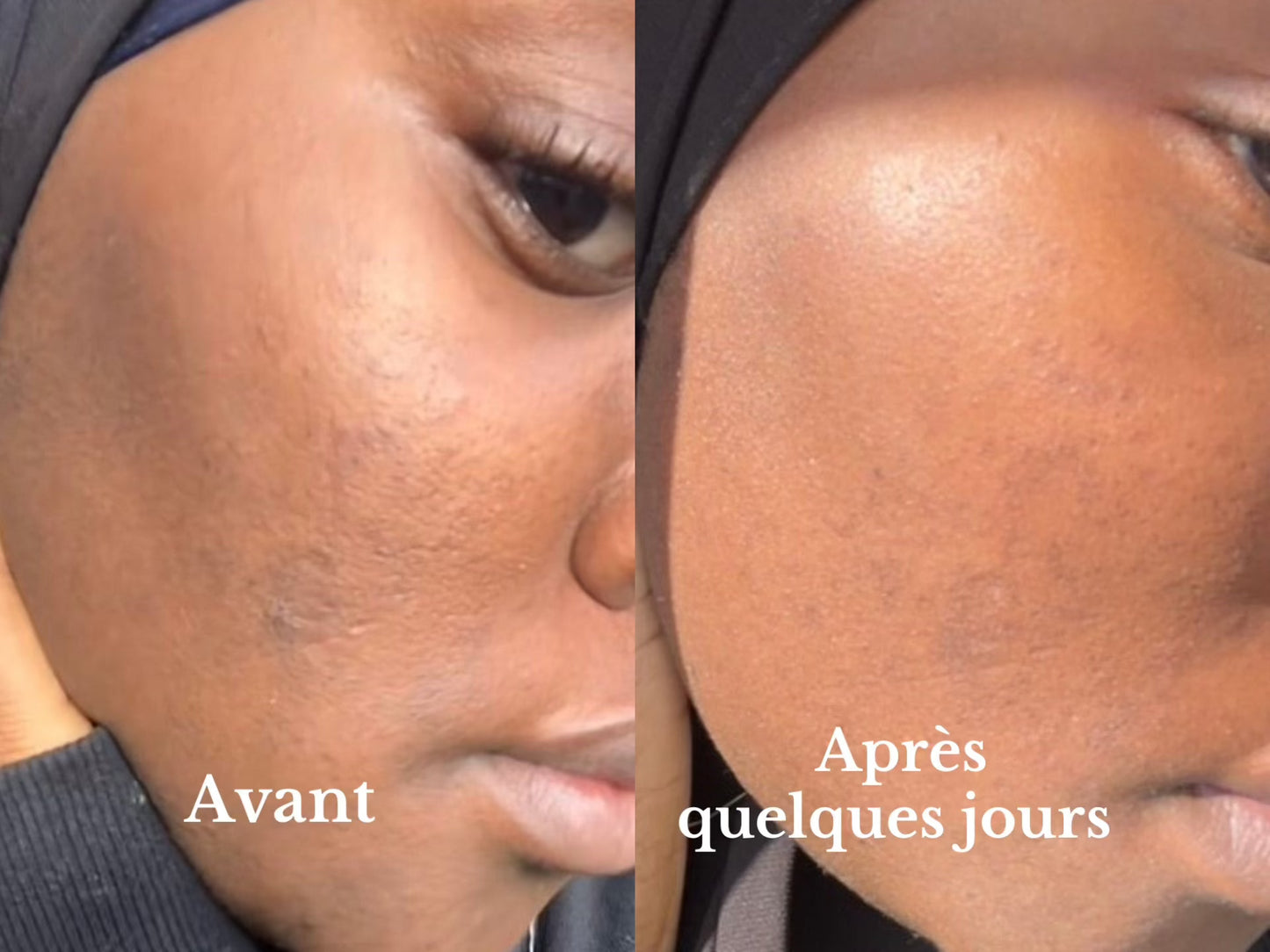 Siyiri Gamme Anti - acné Gamme anti - acné