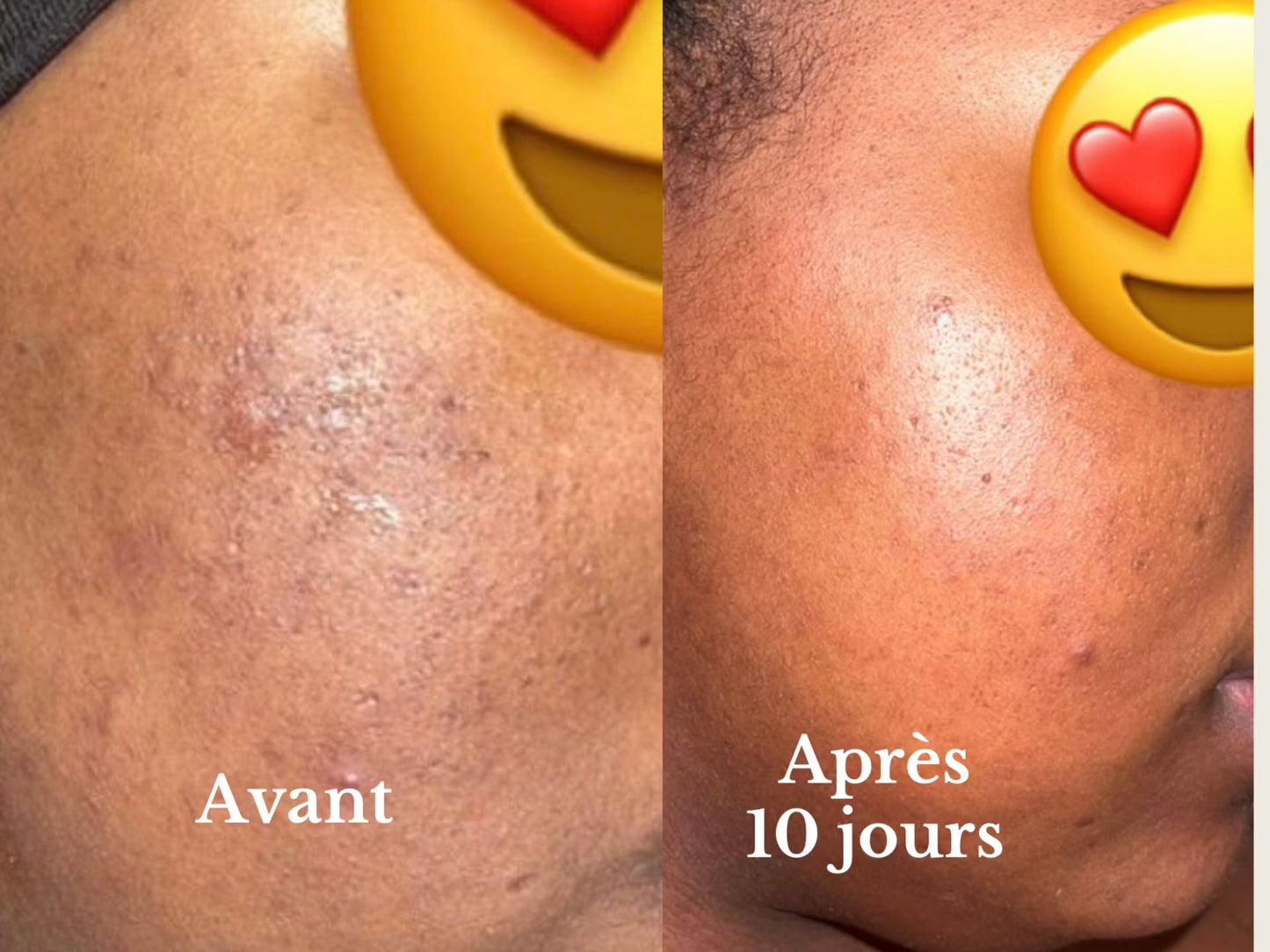 Siyiri Gamme Anti - acné Gamme anti - acné