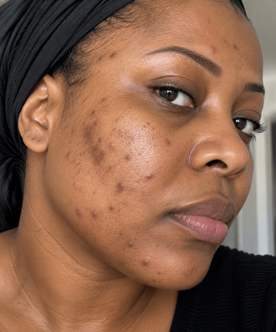 Hyperpigmentation : comprendre les taches brunes et construire une routine adaptée - SIYIRI